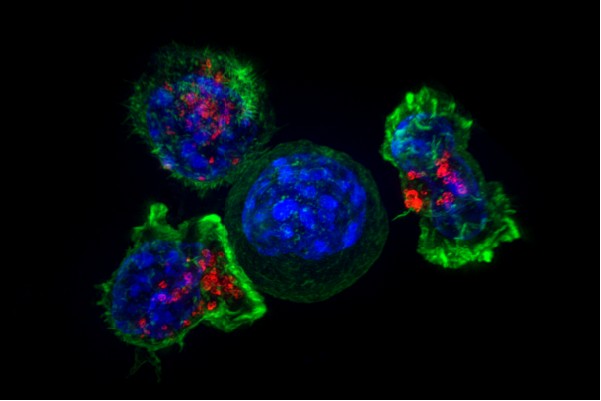 Single-Infusion Blood Cancer Remission: In Vivo JY231 Therapy Trialed in China
