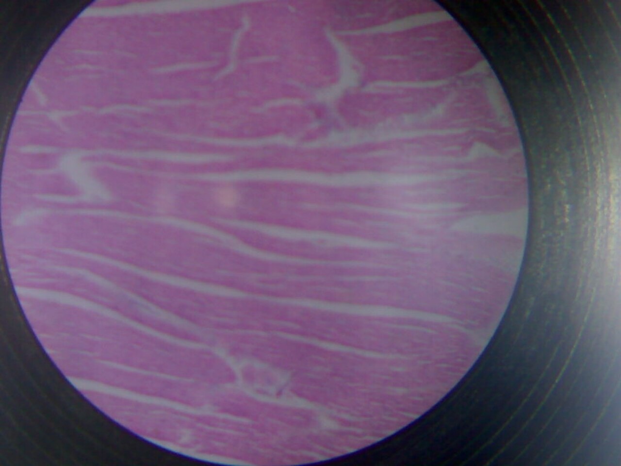Myocardial Fibrosis Regression: In Vivo LNP-mRNA Therapy